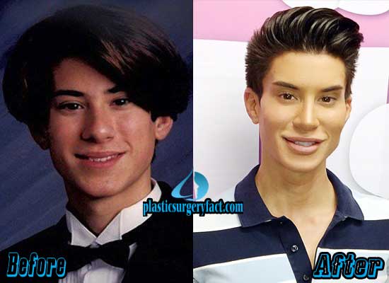 Human-Ken-Doll-Plastic-Surgery-Before-and-After.jpg